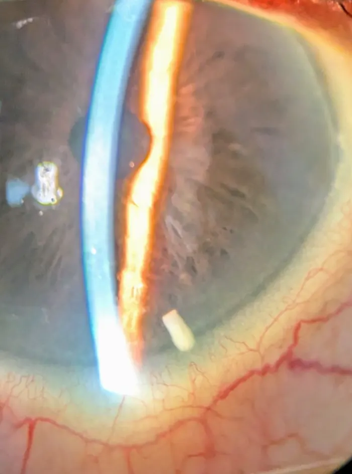 Durysta sustained-release implant in the eye
