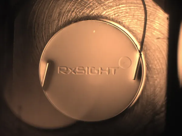 Light Adjustable Lens (LAL)